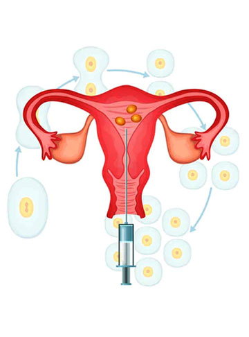 IUI कृत्रिम गर्भाधान तकनीक की प्रक्रिया