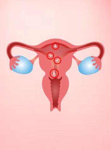 Endometrial Polyp