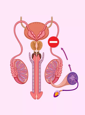 3 Types of Infertility: Understanding Causes and When to Seek Help
