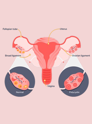 PCOD vs PCOS: मुख्य अंतर, लक्षण और उपचार