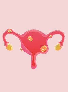 Fibroid Meaning in Hindi