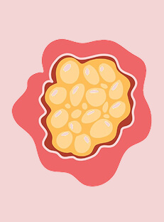 Ovarian Cyst Meaning in Hindi