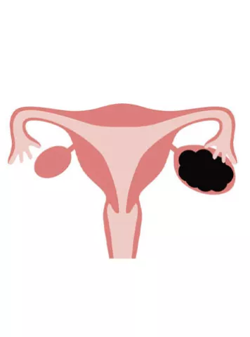 Chocolate Cyst (Ovarian Endometrioma)
