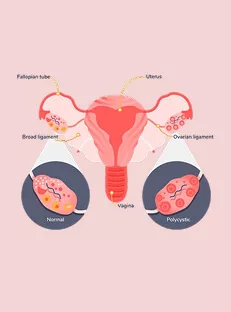 PCOD vs PCOS